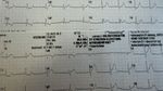 EKG-Rythmus